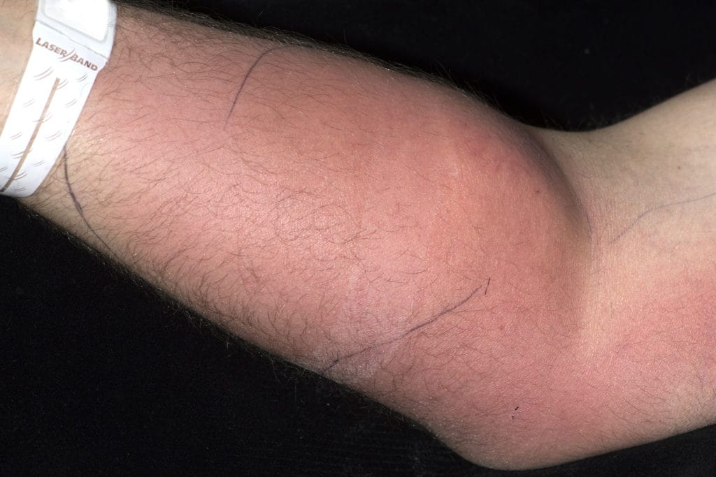 Homem desenvolve infecção após injetar sêmen no braço para tratar dor nas costas