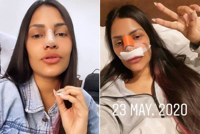 Flay faz rinoplastia e explica que “carnezinha” no nariz atrapalhava na hora de cantar