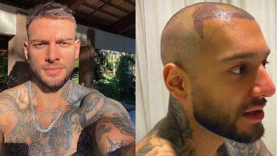 Lucas Lucco mostra resultado de transplante capilar que durou sete horas