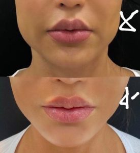 Gracyanne Barbosa mostra antes e depois do emagrecimento facial veja foto