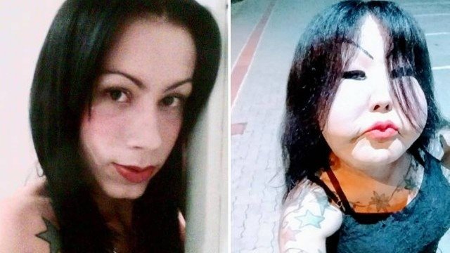 Transexual chamada de fofao faz vaquinha para reverter procedimento estetico mal feito