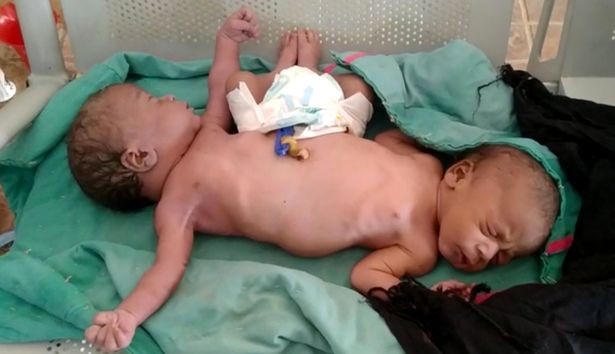 Gêmeas siamesas nascem com duas pernas e quatro braços na Índia