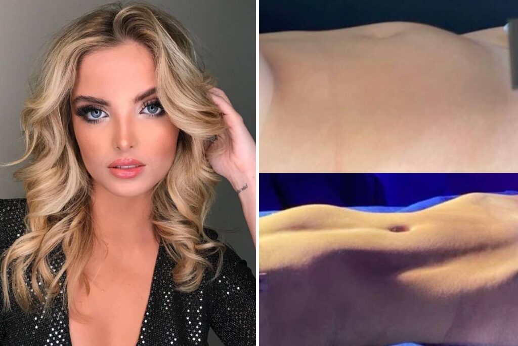 Apos criticas atriz Giovanna Chaves mostra resultado de lipo LAD veja foto