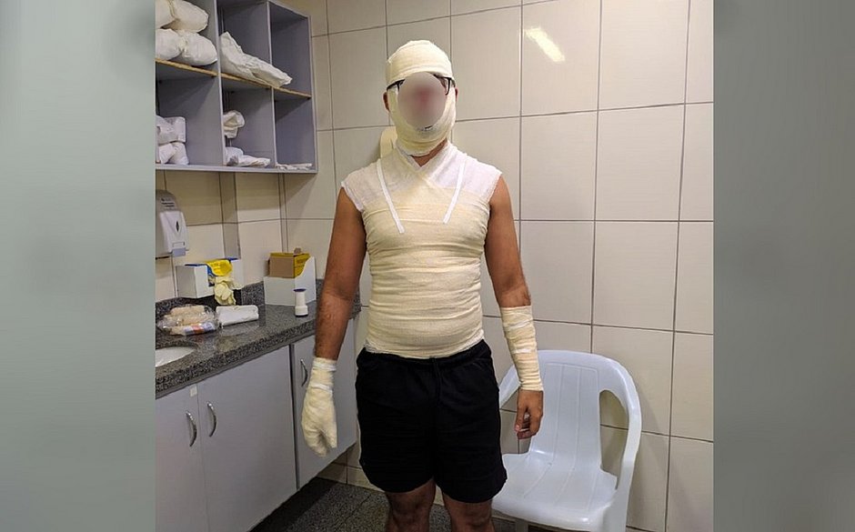 Homem sofre queimaduras apos coxinha explodir Voou igual foguete