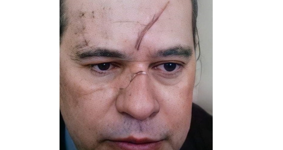 Dias Toffoli surge com hematomas no rosto em sessao do STF 2 1