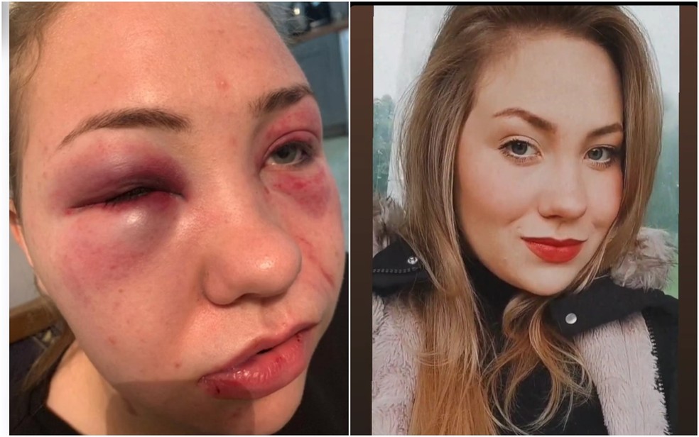 Jovem denuncia que foi espancada por namorado goiano na Irlanda