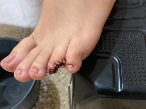 Jovem perde parte do dedo apos ataques de piranhas no Para