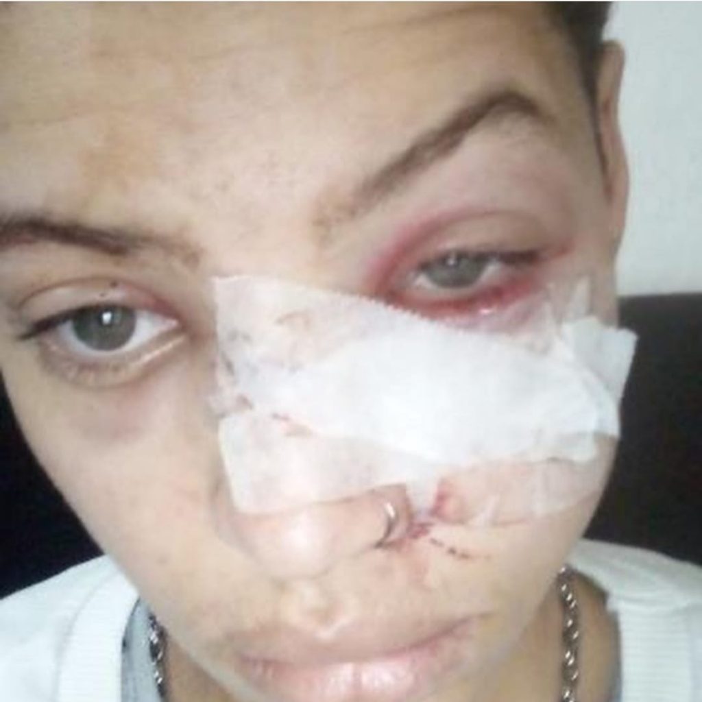 Homem trans e golpeado com facao no rosto e na mao pelo padrasto em Aracaju