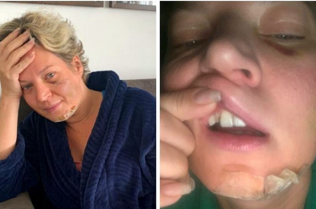 Joice Hasselmann acorda com fraturas no corpo e acredita ter sido vitima de um atentado