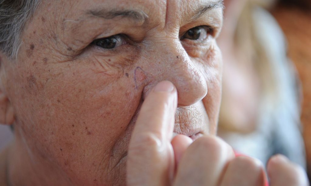Brasileiros devem redobrar cuidados no verao contra cancer de pele
