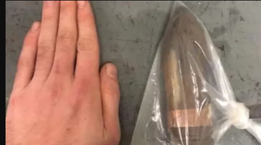 Homem com projetil de canhao no reto faz hospital acionar equipe antibomba